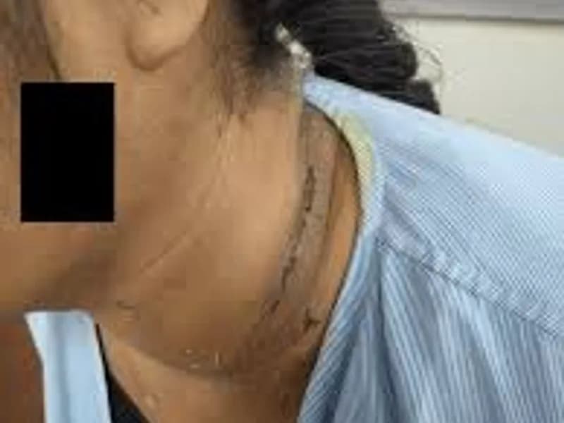 Female Excision of Cystic Hygroma Surgery in Ranchi