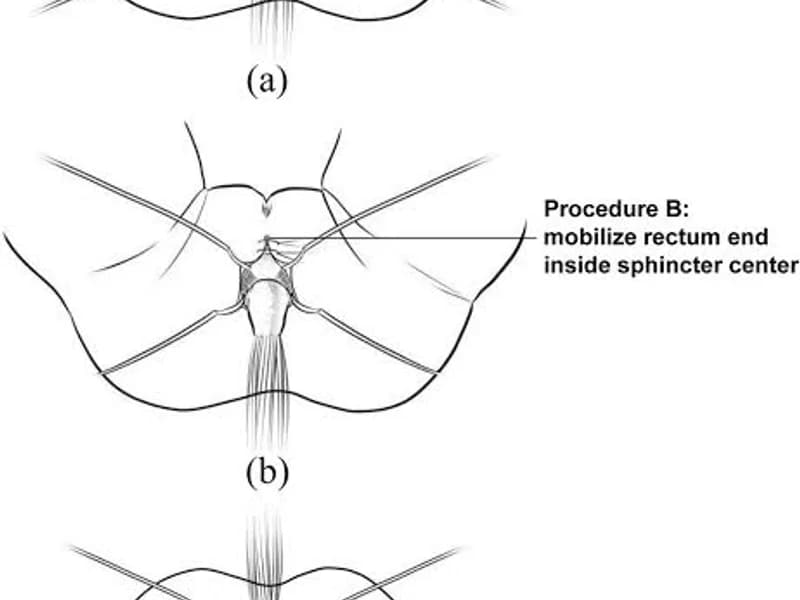 Female Imperforate Anus Low Anomaly Cut Back Operation in Ranchi