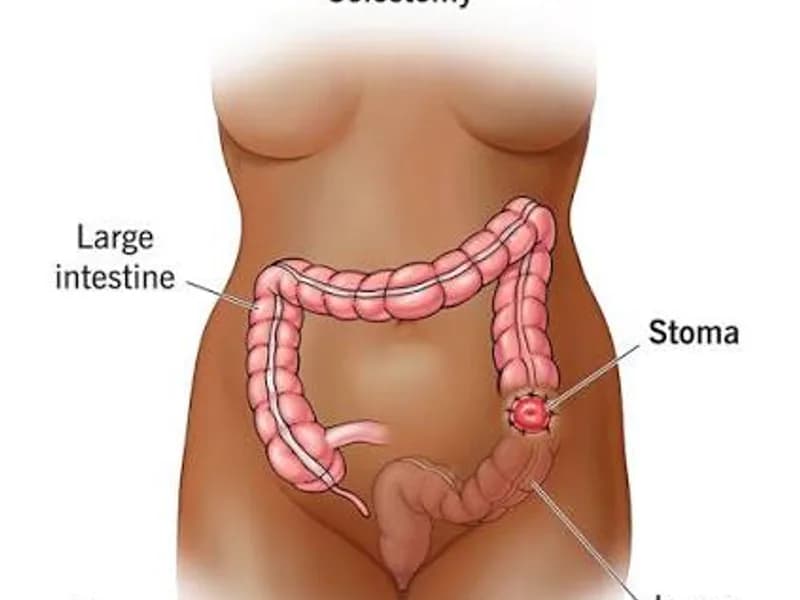 Female Colostomy Surgery in Ranchi