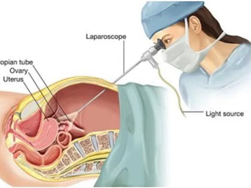 Female Open Abdominal Cyst Operation in Ranchi