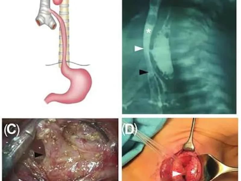 Female Tracheoesophageal Fistula Correction Surgery in Ranchi