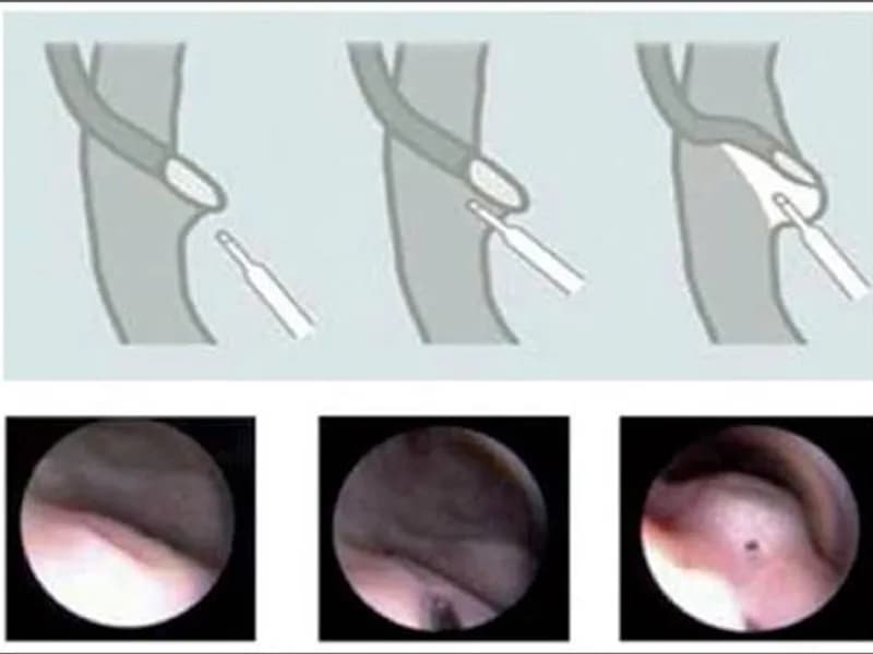 Female Cystoscopic Deflux Injection Surgery in Ranchi