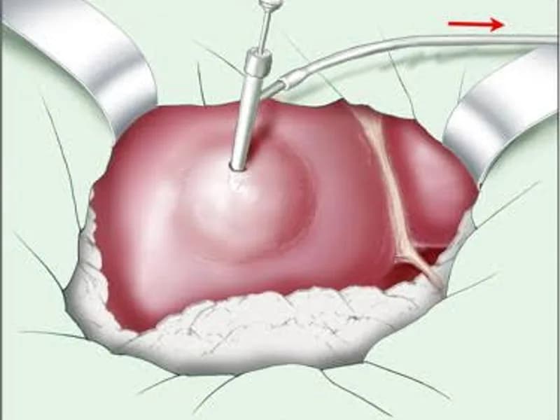 Female Hydatid Cyst Surgery in Ranchi