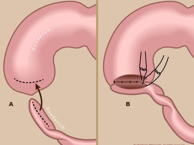 Female Duodenal Atresia Operation Surgery in Ranchi
