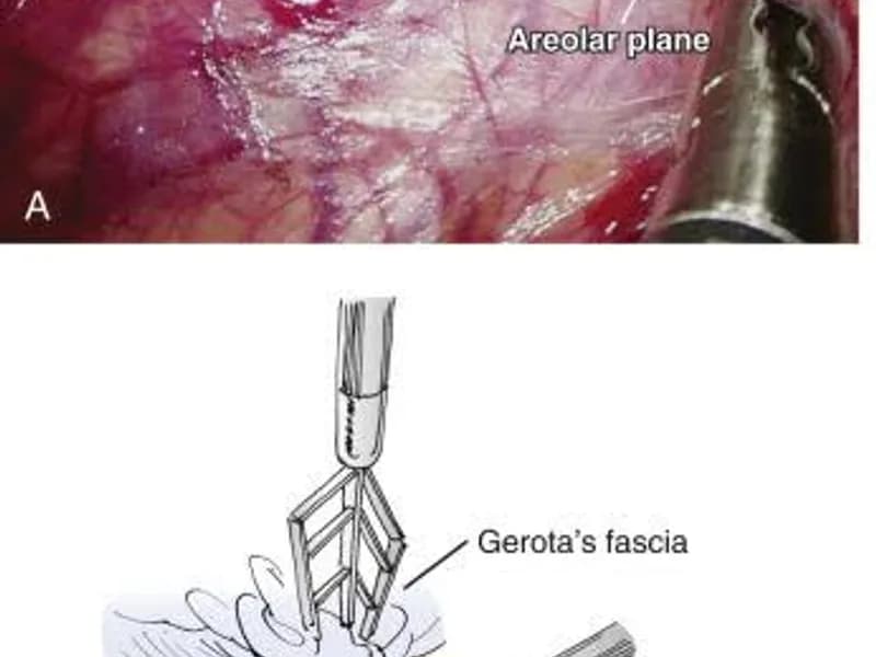 Female Nephrectomy for Pyonephrosis Surgery in Ranchi