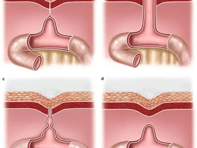 Female Omphalomesenteric Duct Excision Surgery in Dhanbad