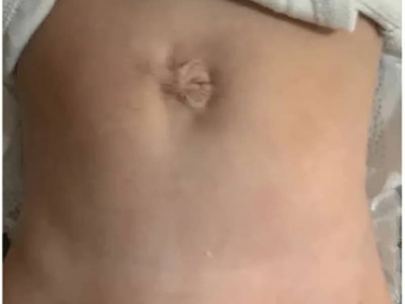Female Gastroschisis Repair Surgery in Dhanbad
