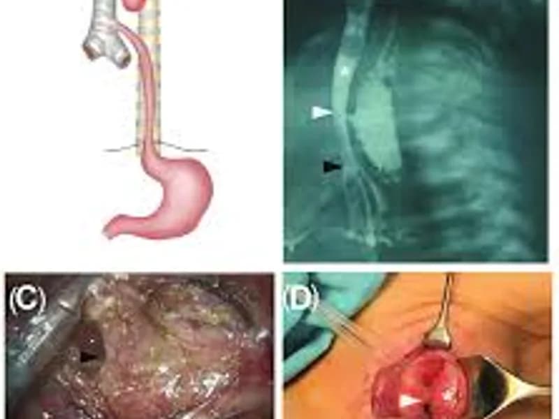 Female TEF Correction Surgery in Dhanbad