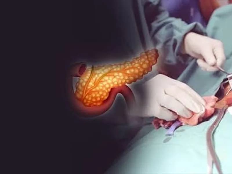 Female Pancreatic Ring Operation Surgery in Dhanbad