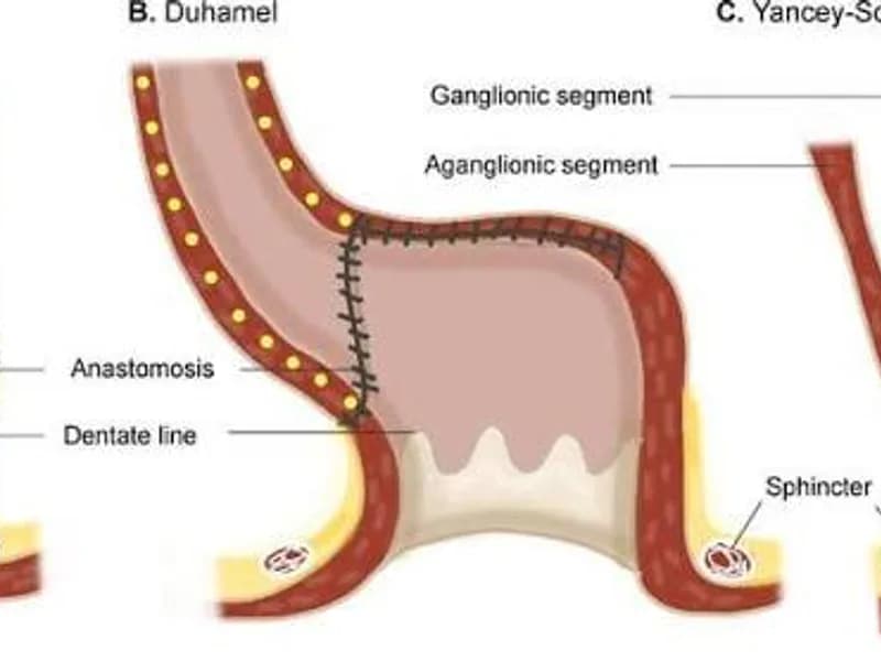 Female Abdominal Perineal Pull Through Hirschsprung Disease Surgery in Dhanbad