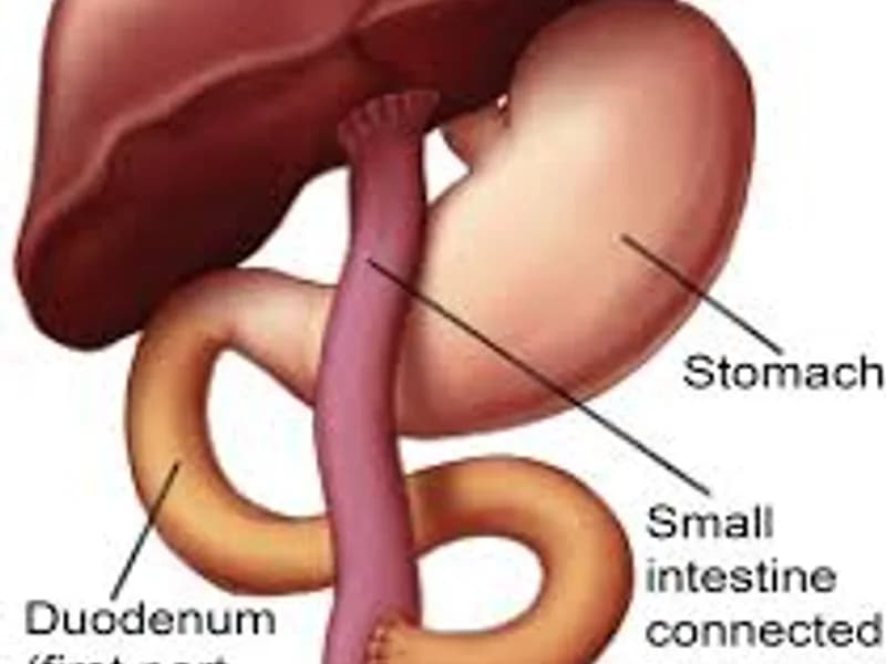 Female Biliary Atresia Surgery in Dhanbad