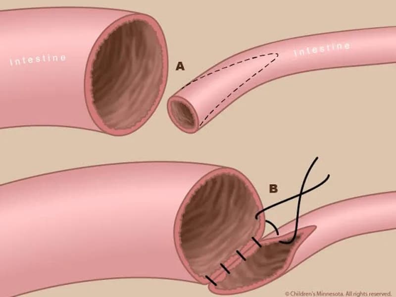 Female Intestinal Atresia Surgery in Dhanbad