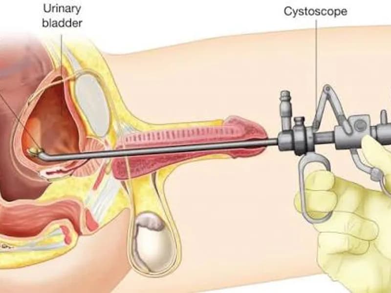 Female Cystolithotomy Surgery in Dhanbad