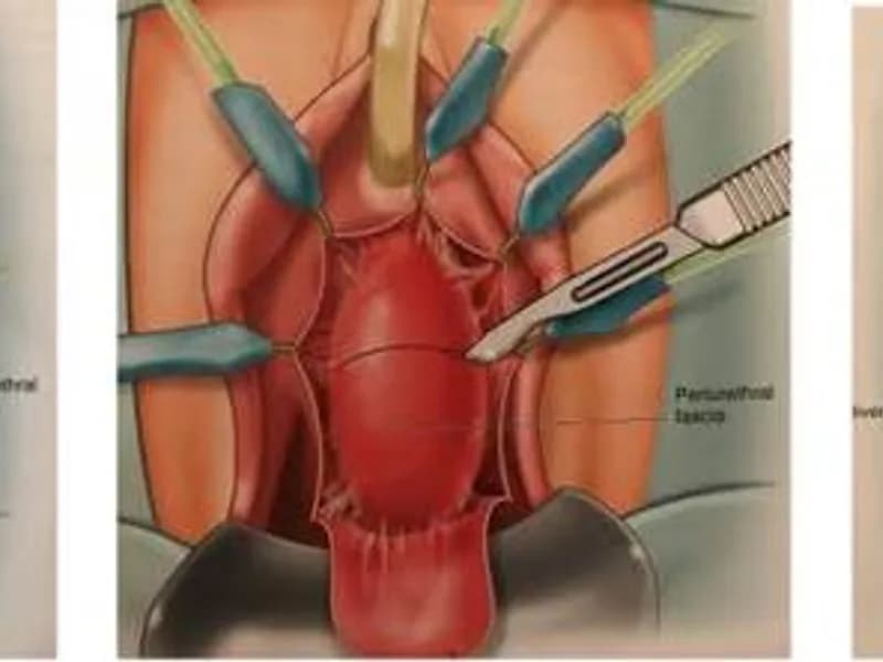 Female Urethral Diverticulectomy Surgery in Dhanbad