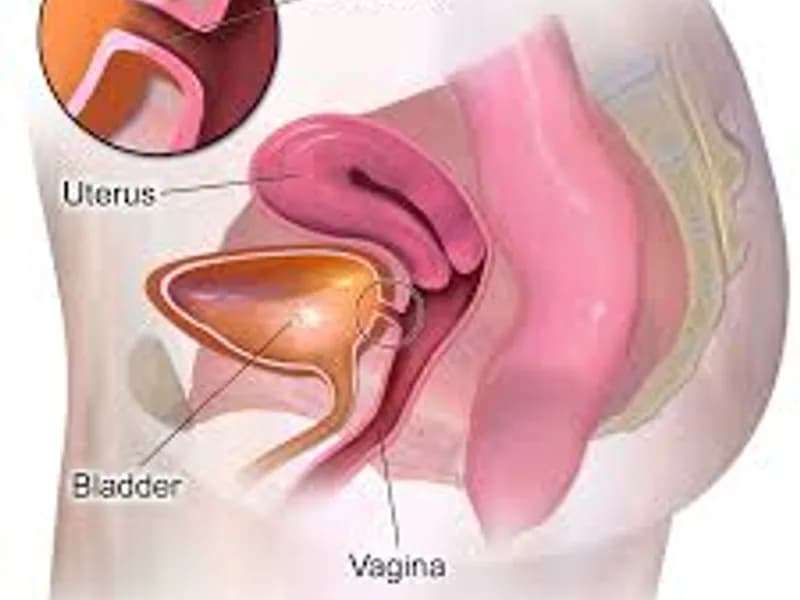 Female Vesicovaginal Fistula (VVF) Repair Surgery