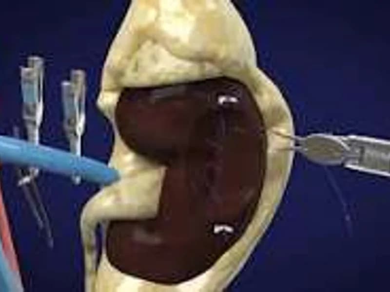 Female Nephrectomy for Pyonephrosis Surgery in Dhanbad