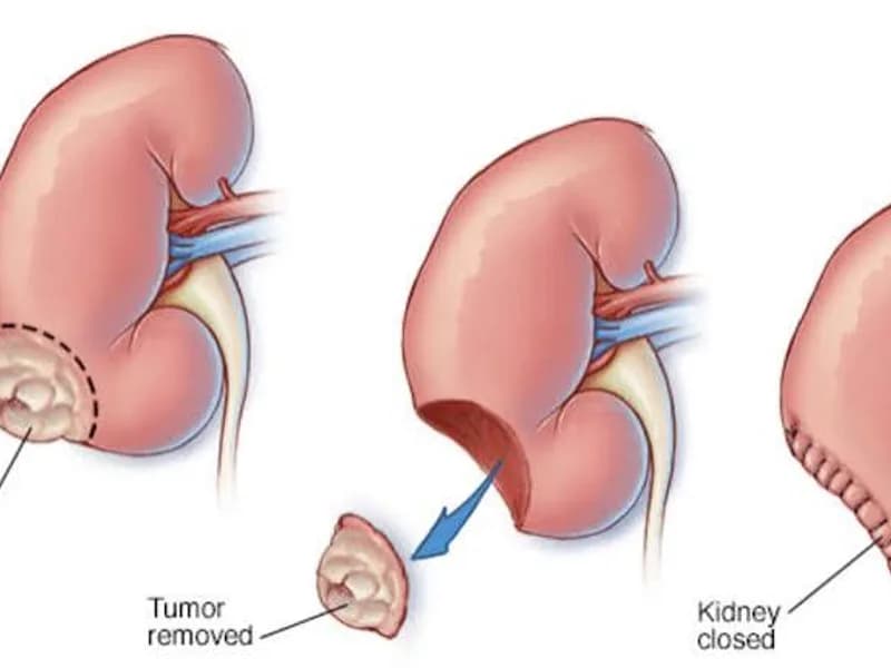 Female Nephrectomy for Wilms Tumour Surgery in Dhanbad