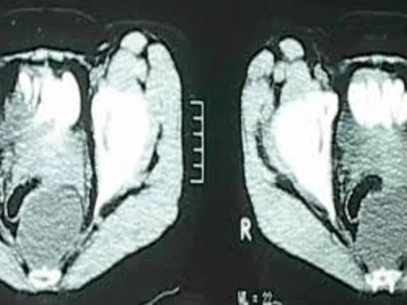 Female Sacrococcygeal Teratoma Excision Surgery Dhanbad