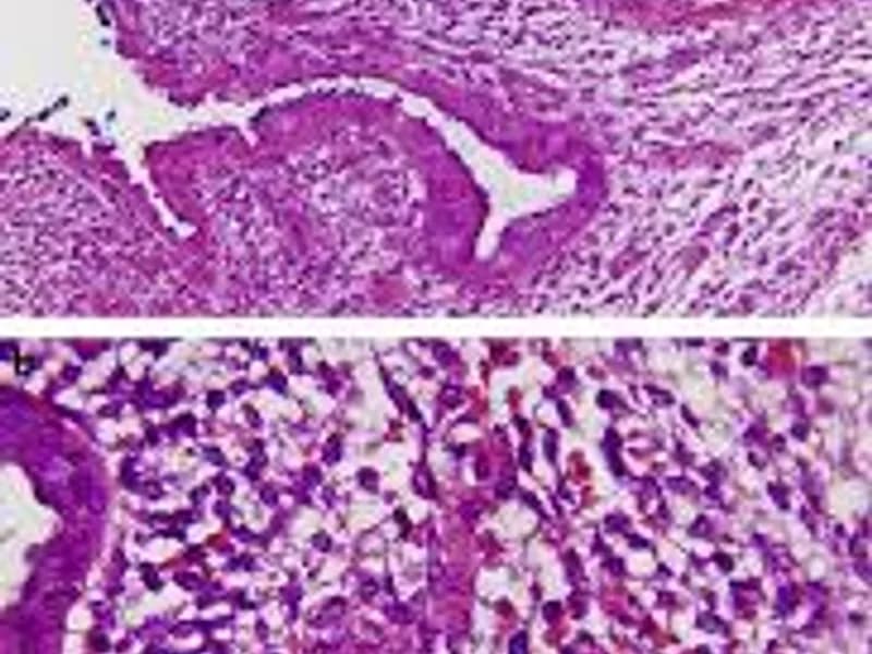 Female Rhabdomyosarcoma Wide Excision Surgery in Dhanbad