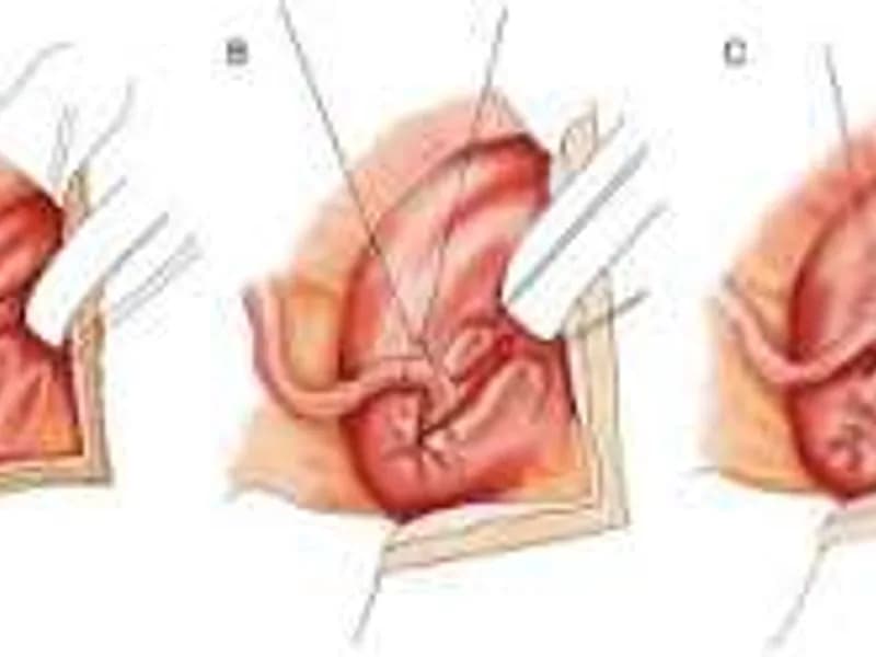 Female Ureteric Reimplantation Unilateral Surgery in Dhanbad
