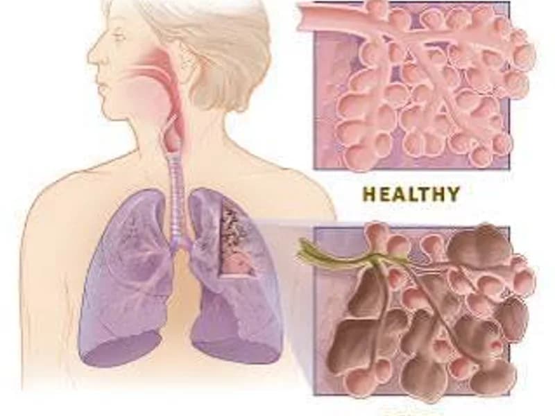 COPD: Causes, Symptoms, Treatment, Prevention & Management