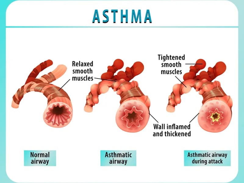 Asthma: Causes, Symptoms, Treatment, and Prevention Guide