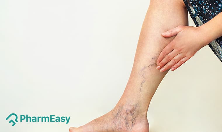 Simple Home Remedies for Varicose Veins: Doctor's Advice