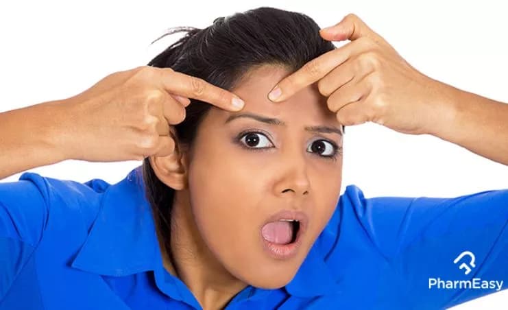 7 Powerful Home Remedies for Acne: Natural Indian Solutions
