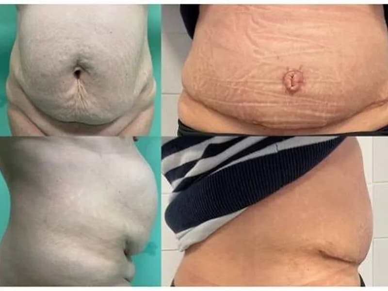 Female Omphalocele Second Stage Hernia Repair Surgery in Ranchi