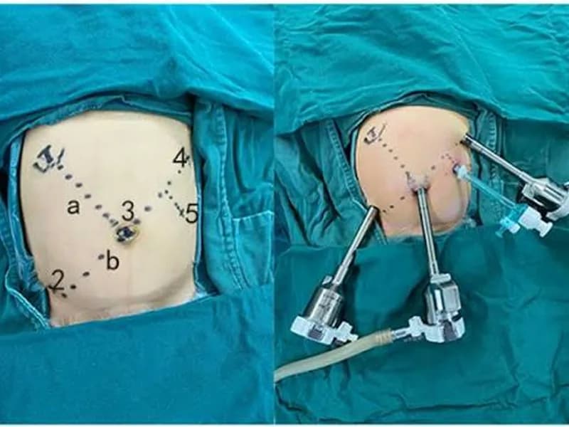 Female Choledochal Cyst Operation Surgery in Ranchi