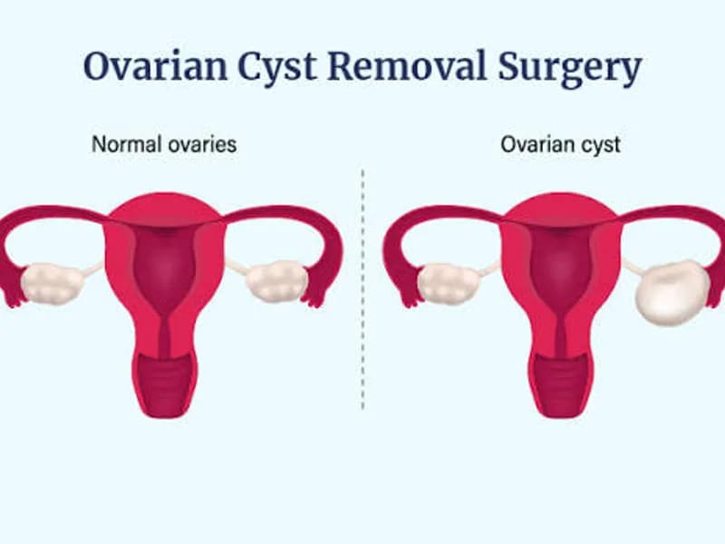 Female Excision of Cyst Surgery in Dhanbad