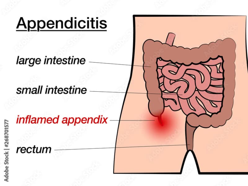 What Is Appendicitis? A Simple Guide to Your Tummy’s Little Tail