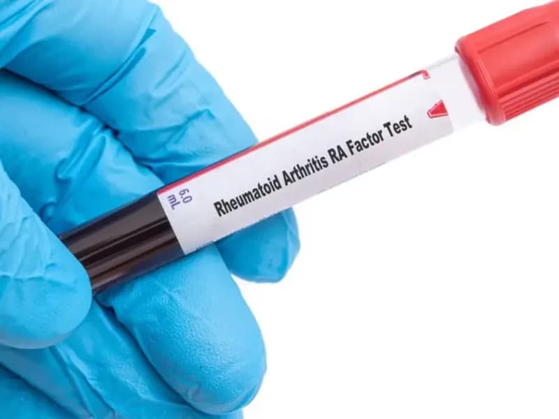 Rheumatoid Disease Wise Blood Test, Meaning, Normal Range, and Causes.